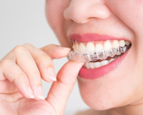 Invisible Braces