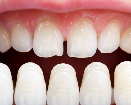 Porcelain Veneers