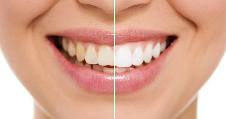 Teeth Whitening